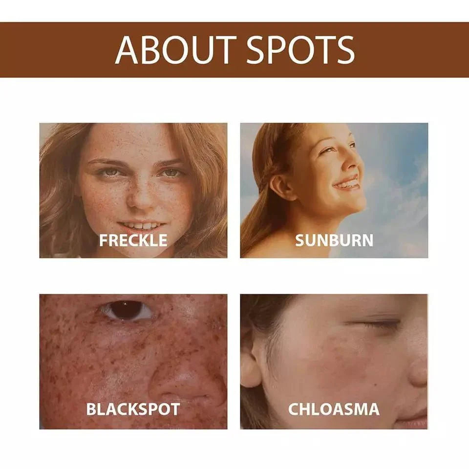 Anti Freckle Serum (30ml) - Zambeel